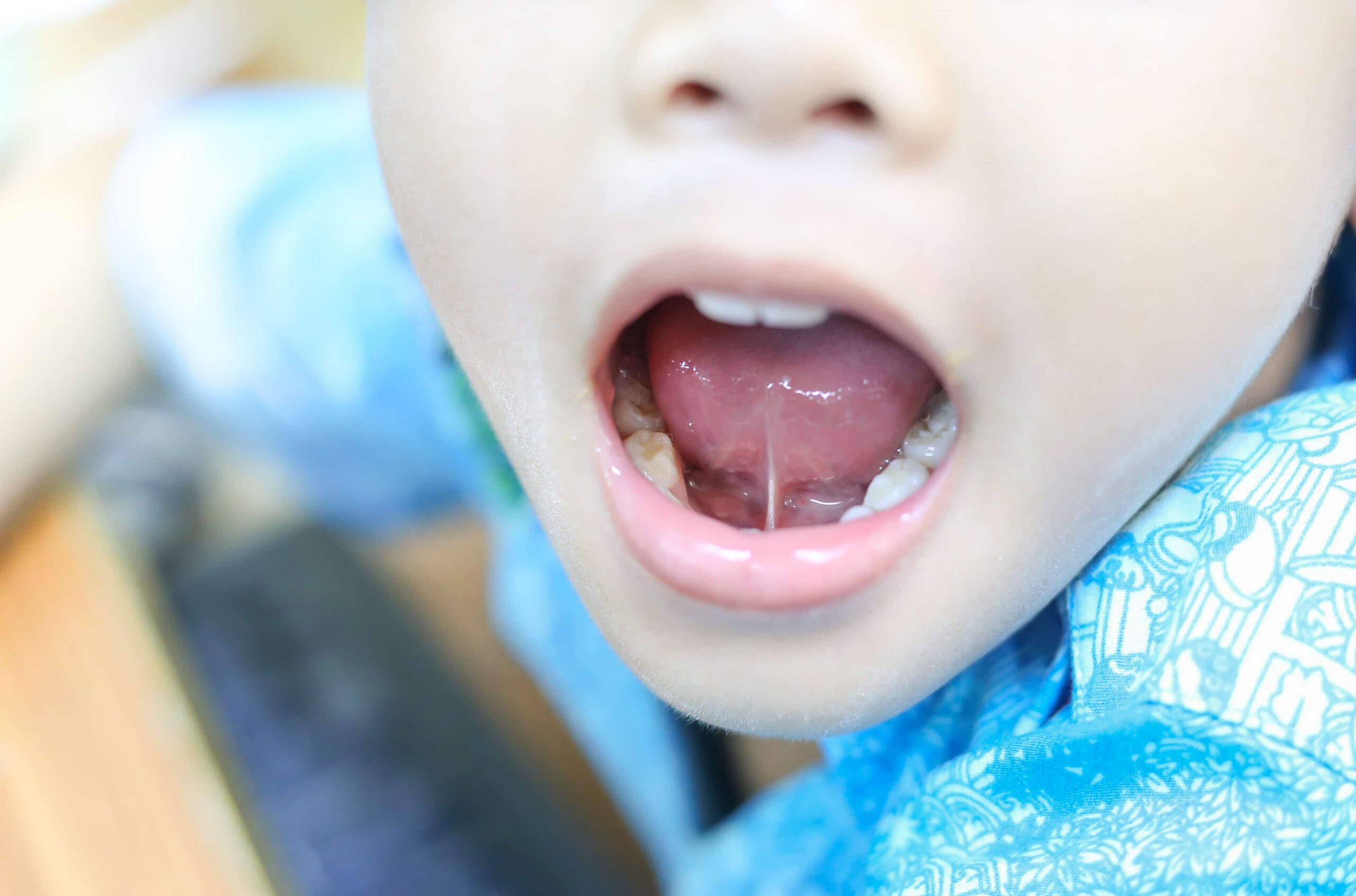 tongue tied patient