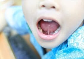 Tongue-tie,Patient,,,Children,Health,Problem,No.3,,He,Show,His