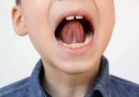 Boy,,Kid,Opened,His,Mouth,,Oral,Cavity,,Close-up,Teeth,,Performs